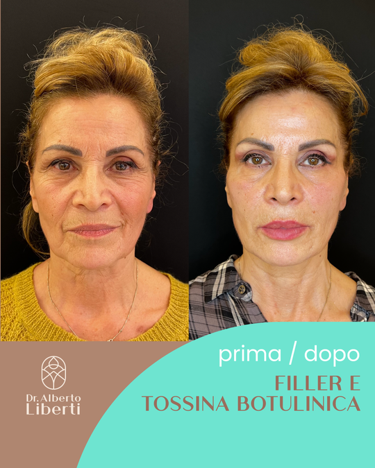 Filler e tossina botulinica
