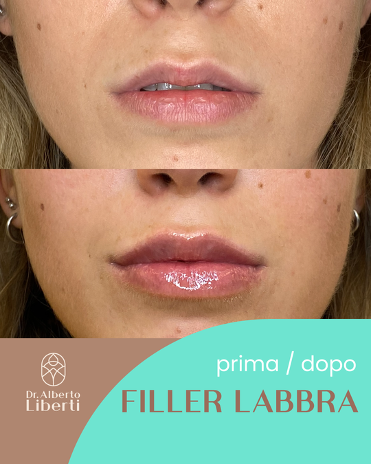 Filler Labbra