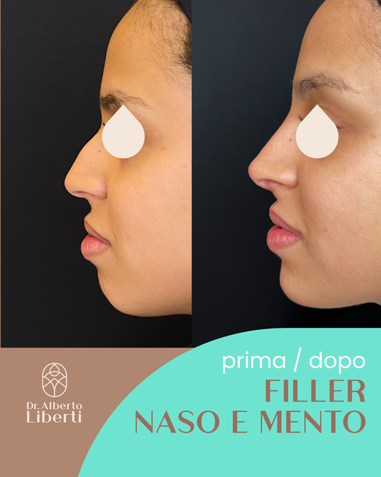 Filler Naso e Mento