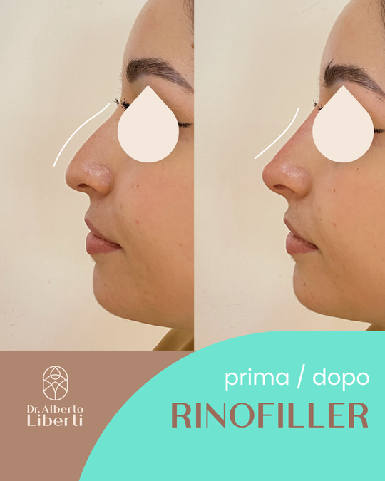 Rinofiller