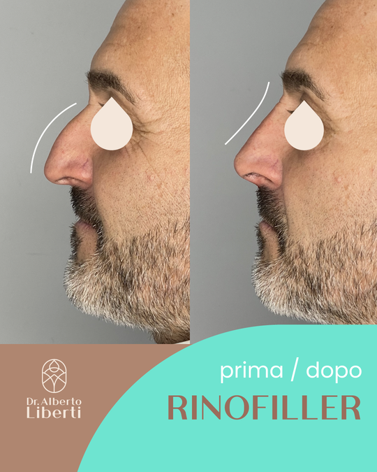 Rinofiller